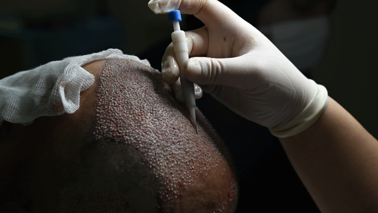 Hair Transplant Post-Operative Aftercare